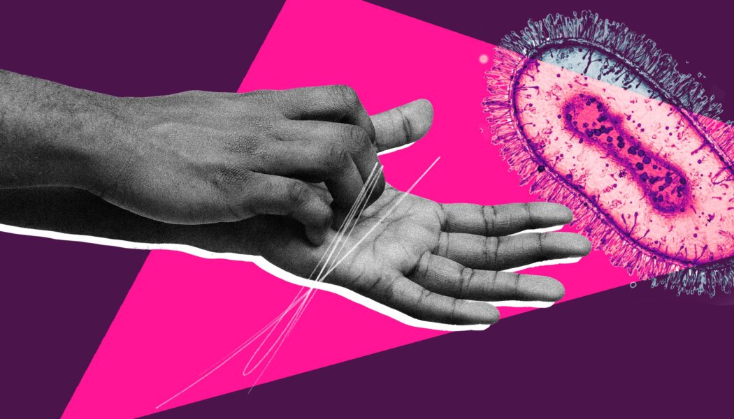 Black and Latinx men are disproportionately vulnerable to mpox, according to new report