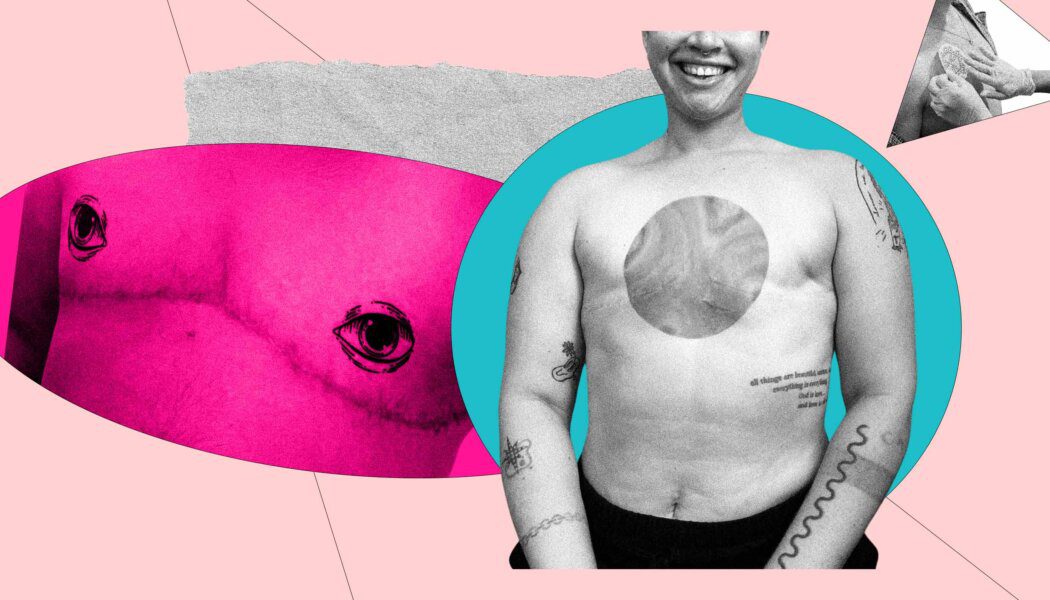 Gender-affirming tattooing can bring post-op euphoria